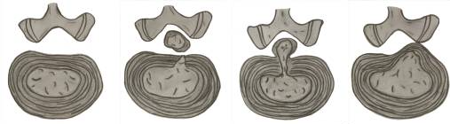 Disc Herniation Varients